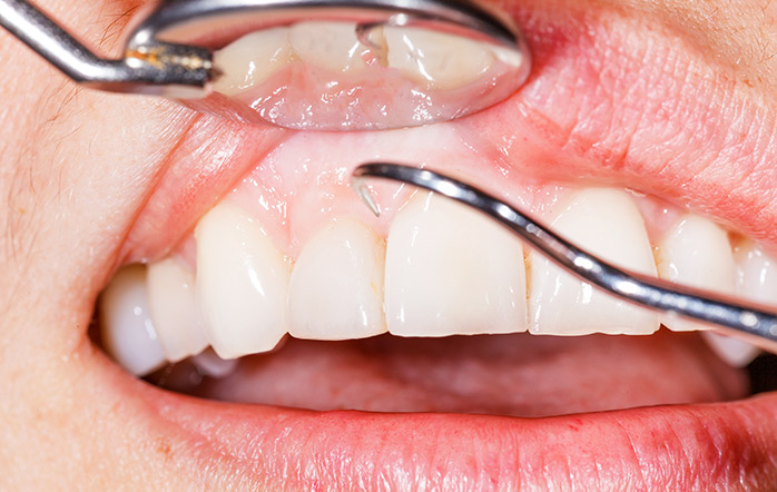 中等度歯周病の治療