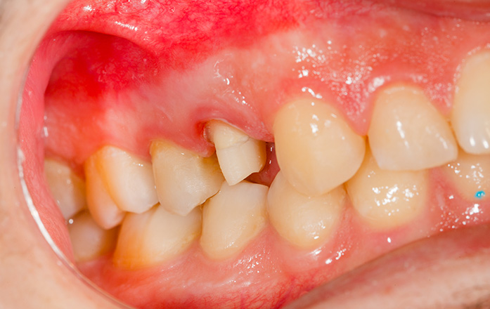 重度歯周病の治療