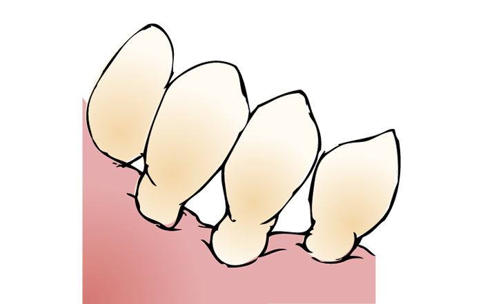 下がった歯茎